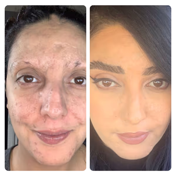 Eyebrow Transplant in Turkey